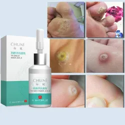 Liquido per la rimozione dei tag della pelle - mole - verruche - lentiggini alleggerimento - 10ml