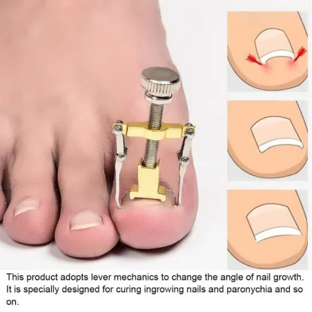 EquiposCorrector de uñas ingrown profesional - elevador - acero inoxidable