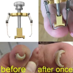 Professional ingrown toenail korjaus - lifter - ruostumaton teräs