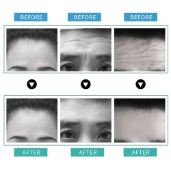 Removal Anti-wrinkle Stickers - Anti-aging