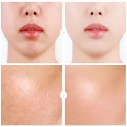 Hyaluronic acid face serum - moisturizing - shrink pores - acne marks removal - nourishing