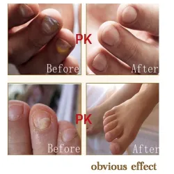Kinesisk medicin - nagelreparation för onykomykos - nagelsvamp - 10 ml