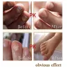 TratamientoMedicina china - reparación de uñas para onicomicosis - hongos en las uñas - 10 ml