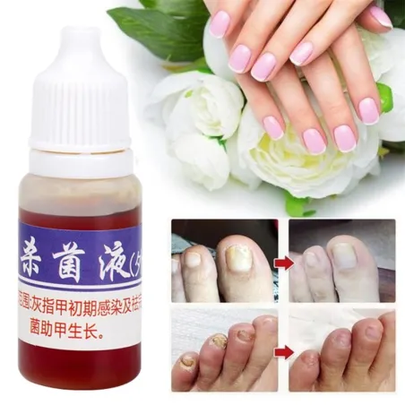 TratamientoMedicina china - reparación de uñas para onicomicosis - hongos en las uñas - 10 ml