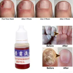 Kinesisk medicin - nagelreparation för onykomykos - nagelsvamp - 10 ml