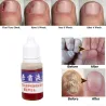 TratamientoMedicina china - reparación de uñas para onicomicosis - hongos en las uñas - 10 ml