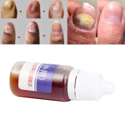 Kinesisk medicin - nagelreparation för onykomykos - nagelsvamp - 10 ml