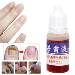 TratamientoMedicina china - reparación de uñas para onicomicosis - hongos en las uñas - 10 ml