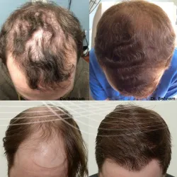 Olio essenziale per la crescita dei capelli - liquido anticaduta - siero
