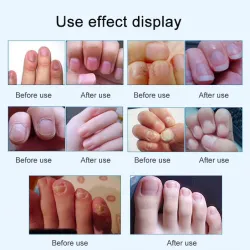 15ml - nail fungal treatment - removal - nails repair liquidTreatment