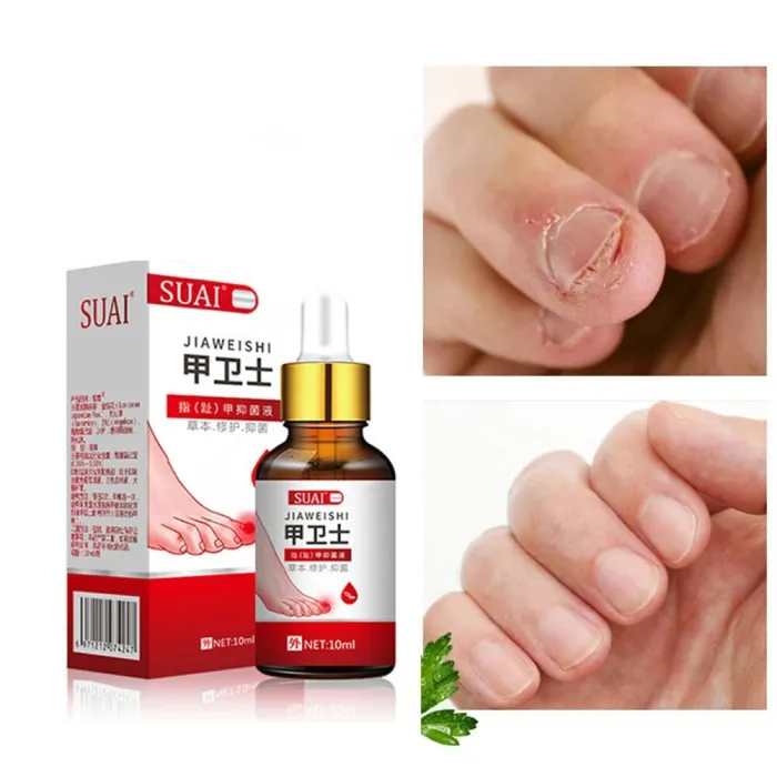 Tånegl sopp fjerning gel - serum - anti infeksjon / paronychia / onychomycosis - 10ml