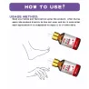 Tånagelsvampborttagningsgel - serum - antiinfektion / paronychia / onychomycosis - 10ml