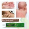 Crème contre le psoriasis - dermatite - eczéma - anti-démangeaisons - pommade antibactérienne à base de plantes