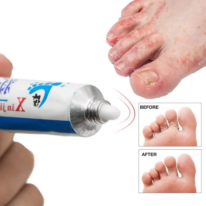 Antibakteriell fotsalva - anti-klåda - borttagning av majs - anti-svett - anti-lukt - psoriasis