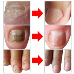 TratamientoAceite de eliminación de onicomicosis - suero líquido de esencia