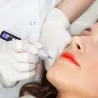 Stylo à plasma laser - élimination des taches de rousseur / taupe / taches brunes - écran LCD LED