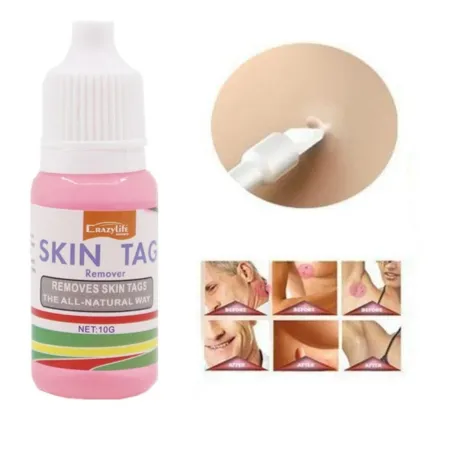 Ihomerkkien poisto - jalkasyyliä - lääketieteellistä nestettä - 10ml - 2 kpl