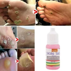 Ihomerkkien poisto - jalkasyyliä - lääketieteellistä nestettä - 10ml - 2 kpl