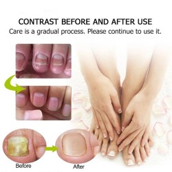 Leczenie grzybicy paznokci - krem do rąk / stóp / paznokci - żeń-szeń - 15 grLeczenie
