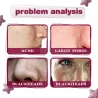 Ansiktsserum - fruktsyreessens - AHA - BHA - aknebehandling - bleking - 30ml