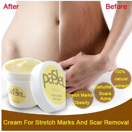 Stretch marks & arpien poistaminen kerma