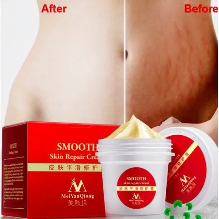 Stretch marks & arpia poistaminen korjaus kehon kerma