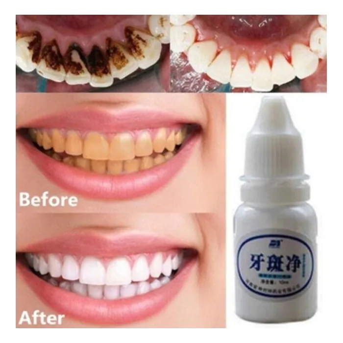 Água de branqueamento de dentes 10 ml