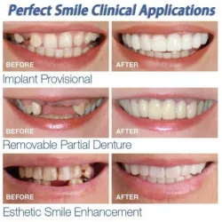 Silicone teeth cover - denture 2 pieces